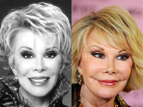 celebrity who died during plastic surgery